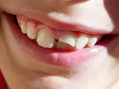 Childrens-teeth-break